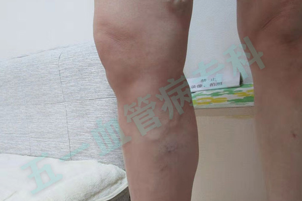 沈阳静脉曲张科普：如何有效预防，守护你的健康血管