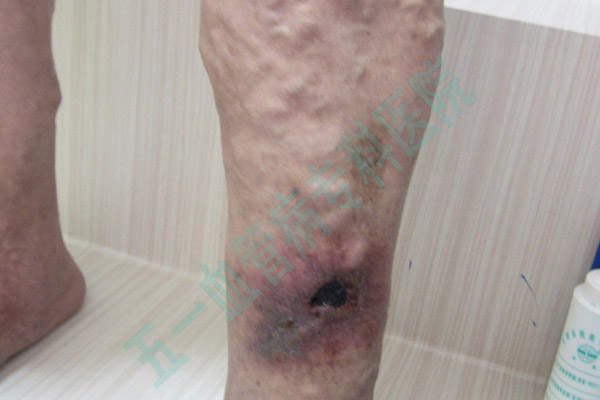 沈阳治疗静脉曲张的新选择五一静脉曲张专科医院