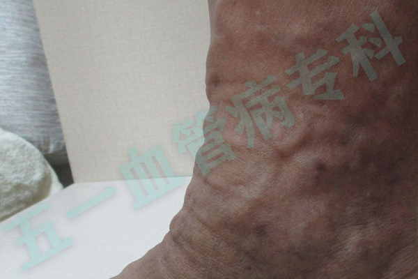 沈阳看静脉曲张医院推荐攻略：告别“小蚯蚓”，重拾健康双腿